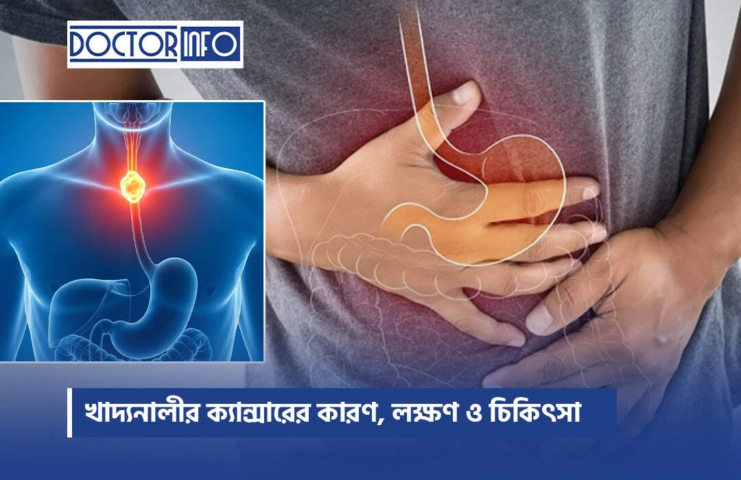 Esophageal cancer causes, symptoms, and treatment